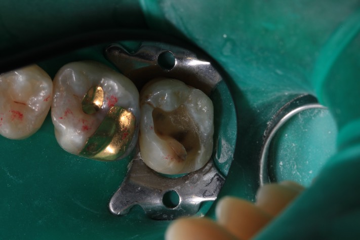 Mendel Sato #2 amalgam removal