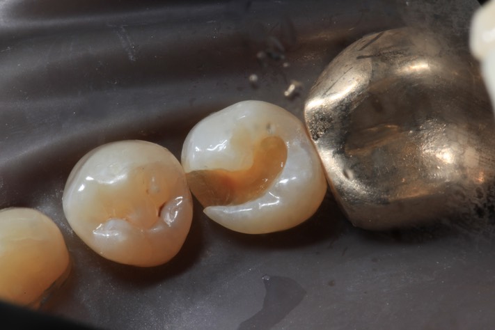 Larry Fujioka #20 composite removal