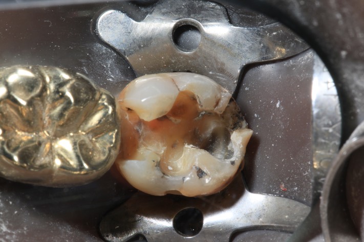 Alan Tamashiro #18 amalgam removal