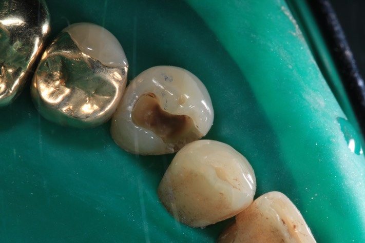 Scott Kanamori #28 amalgam removal