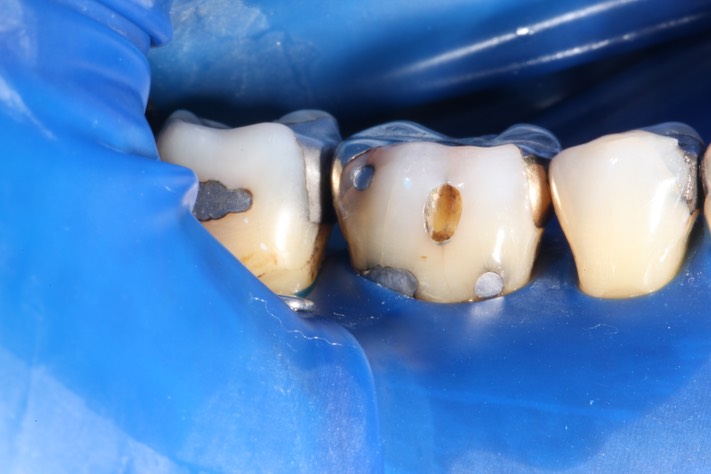 Mark Chun #30 amalgam removal
