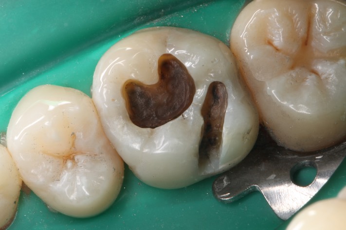 Wes Sato #3 amalgam removal