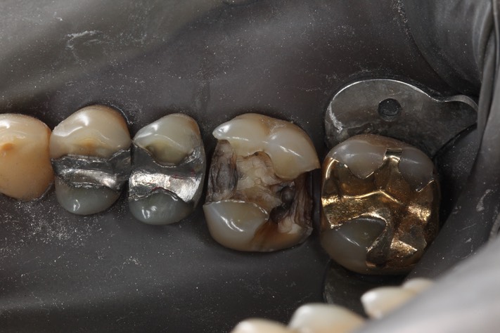 Alan Tamashiro #3 amalgam removal