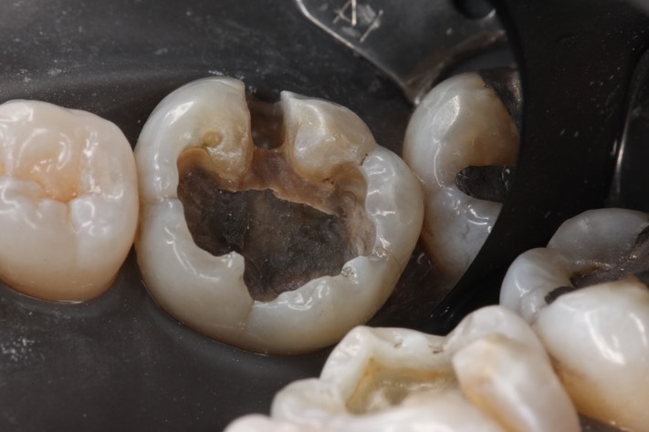 Frank Fukuda #19 amalgam removal