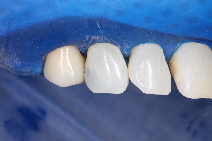 Mark Chun #6 labial view