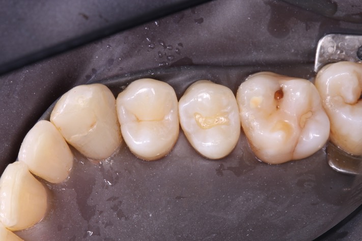 Mason Savage #4 pre-op