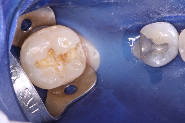 Carl Kobayashi #19 comp removal