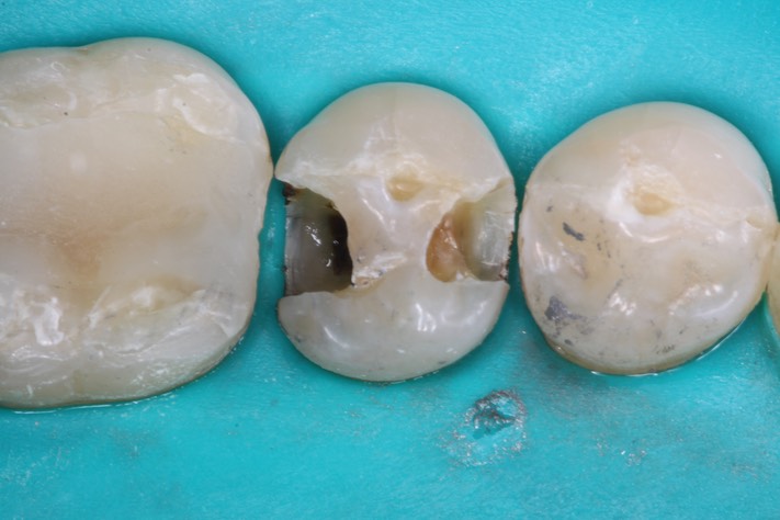 Mitchell Chun #29 amalgam removal