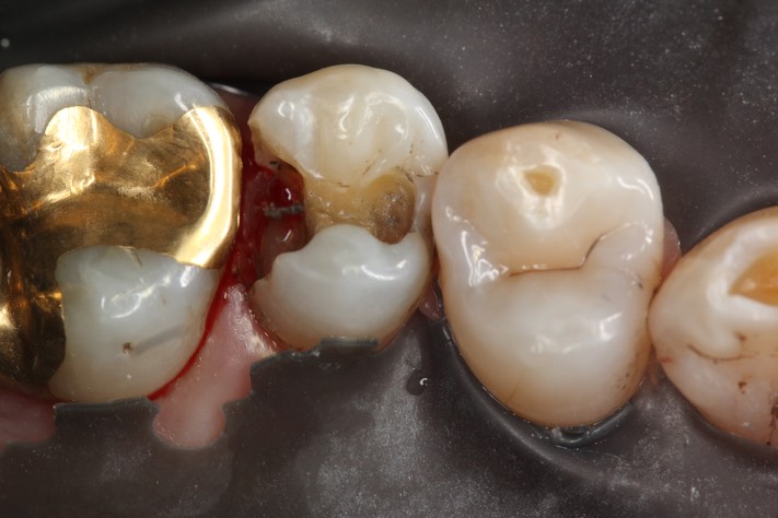 Brian Sato #13 amalgam removal