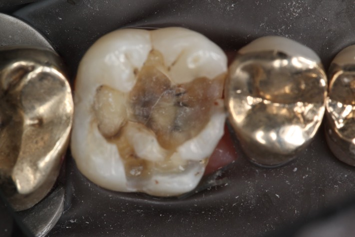 Larry Fujioka #14 amalgam removal