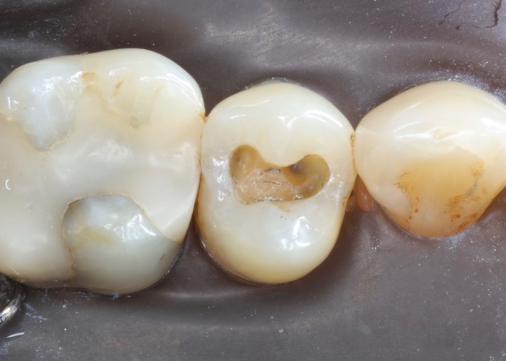 Joe Cha #13 amalgam removal