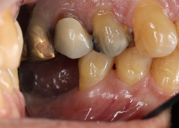 Joe Cha #20 occlusion pre-op