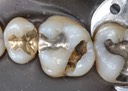 Joe Cha #3 amalgam removal
