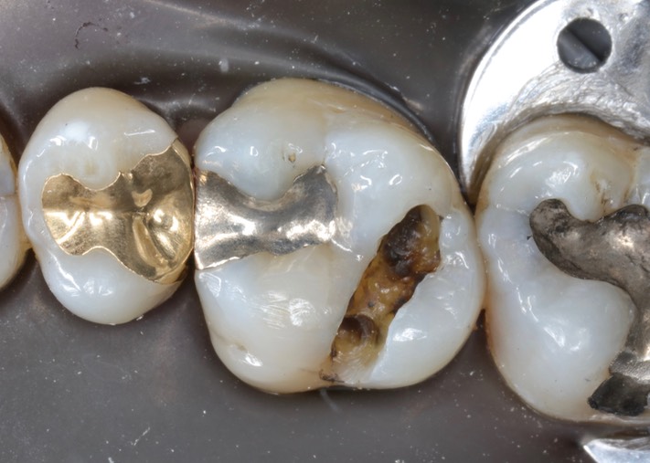 Joe Cha #3 amalgam removal