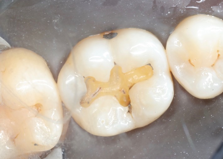 Joe Cha #30 amalgam removal