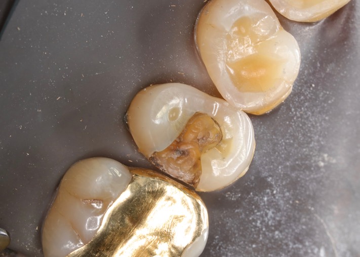 Joe Cha #4 caries removal 