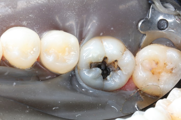 Kris Nip #19 amalgam removal