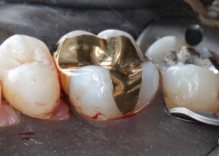 Kris Nip #3 finish lingual