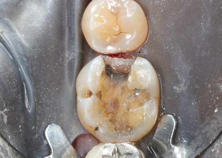 Kris Nip #30 amalgam removal