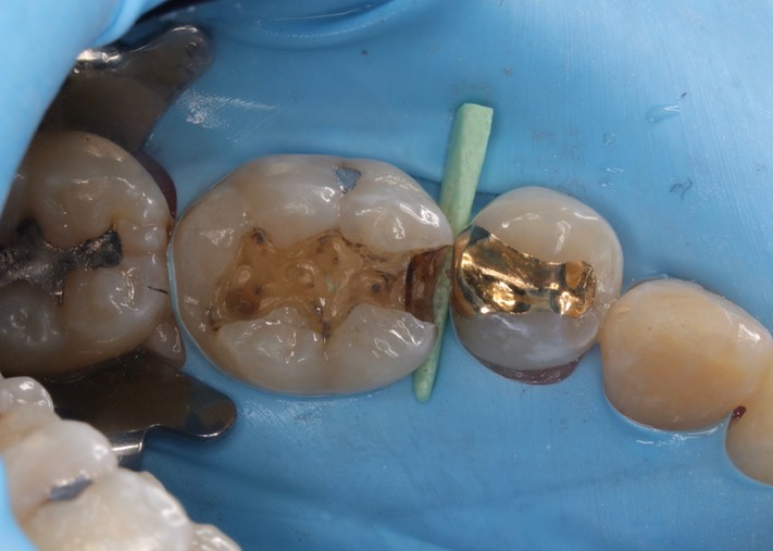 Kris Nip #30 amalgam removal