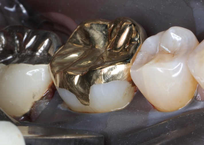 Kris Nip #30 finish buccal