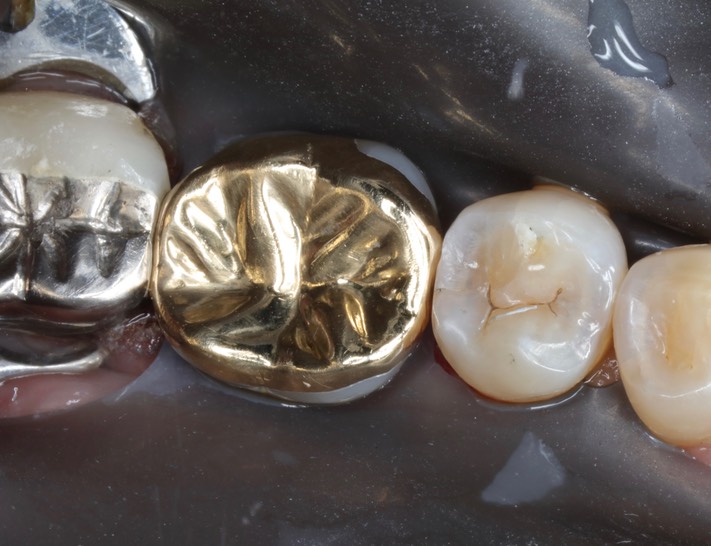 Kris NIp #30 finish occlusal