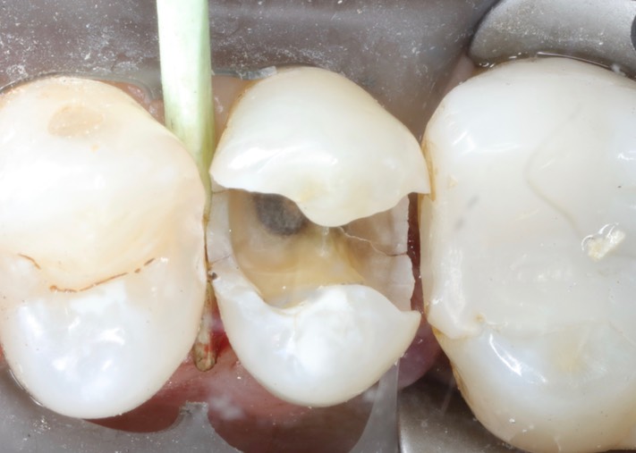 Kris Nip #4 vertical fracture