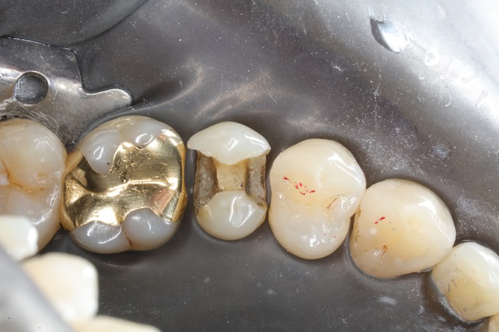 Kyle Chock #13 amalgam removal