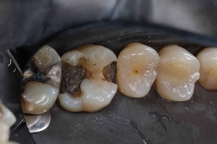 Kyle Chock #14 amalgam removal