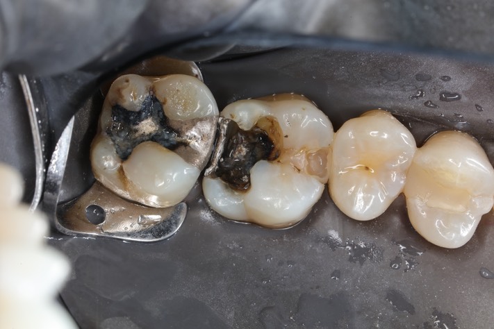 Kyle Chock #14 pre-op