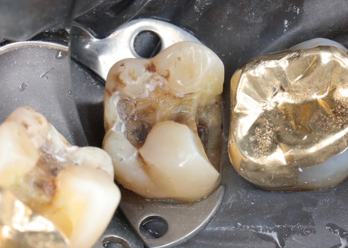 Kyle Chock #15 caries removal