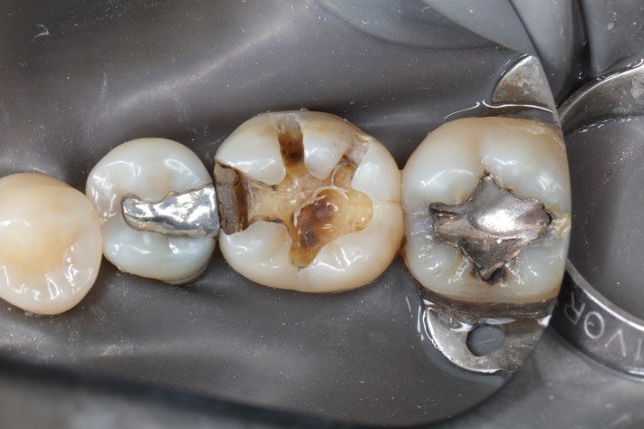 Kyle Chock #19 amalgam removal