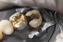 Kyle Chock #2 caries removal