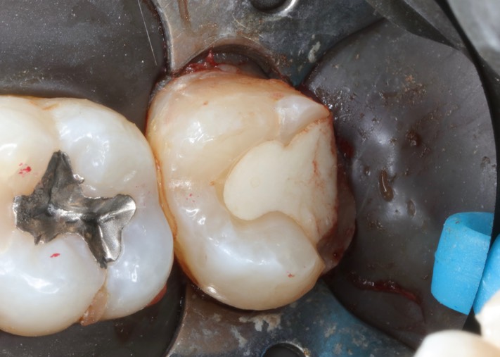 Kyle Chock #2 pre-op