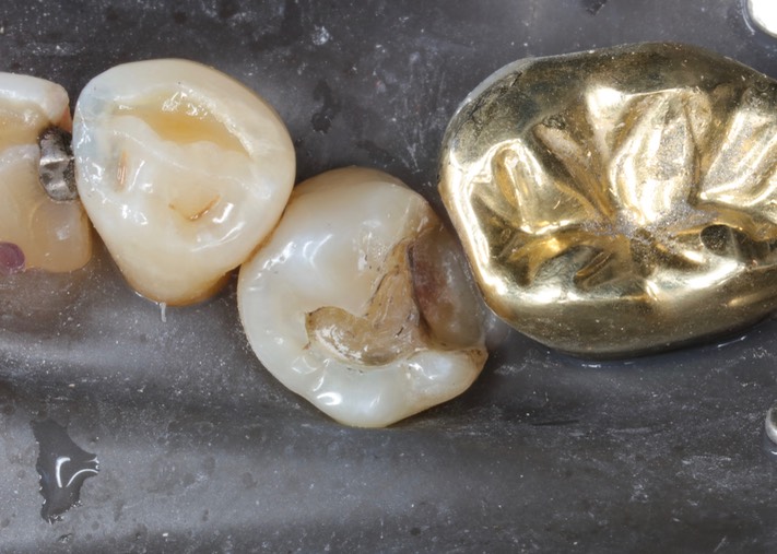 Kyle Chock #20 amalgam removal