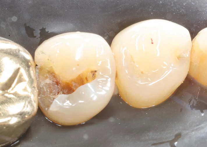 Kyle Chock #29 amalgam removal