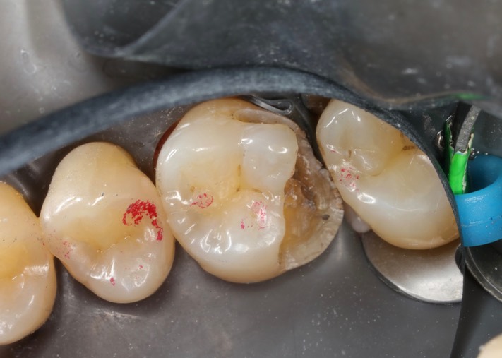 Kyle Chock #3 caries removal