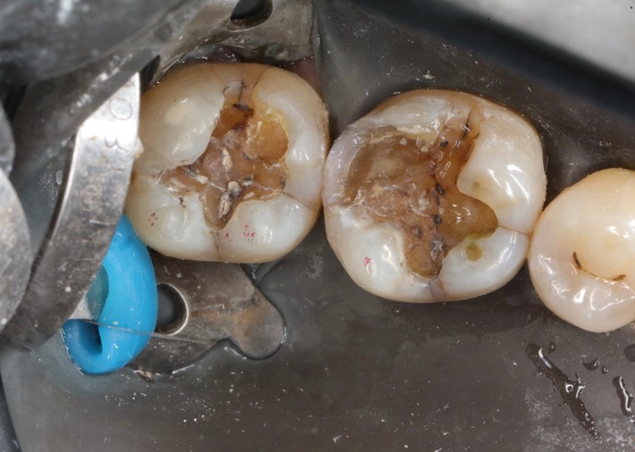 Kyle Chock #30-31 amalgam removal 3