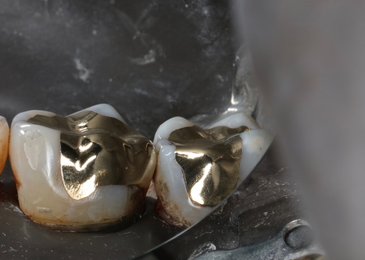 Kyle Chock #30-31 buccal view