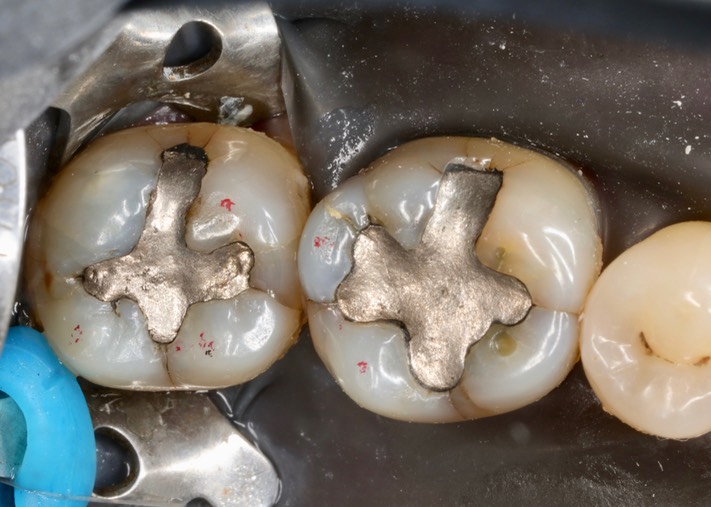 Kyle Chock #30-31 pre-op