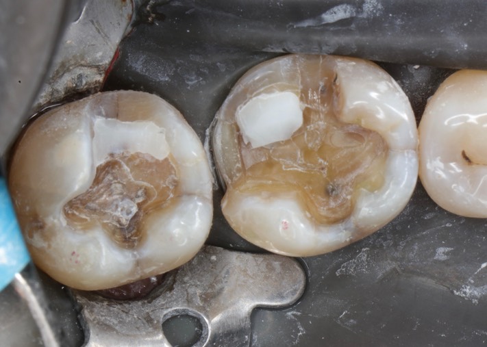 Kyle Chock #30-31 prep