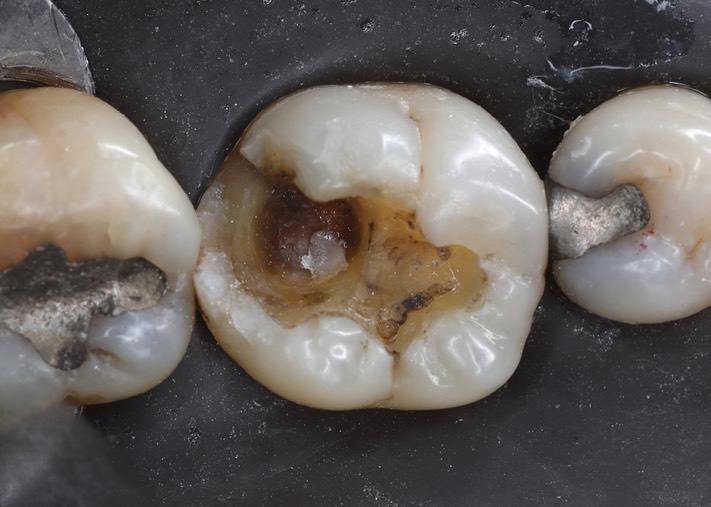 Kyle Chock #30 caries removal