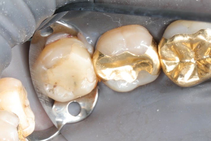 Kyle Chock #32 pre-op