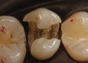 Kyle Chock #4 caries removal