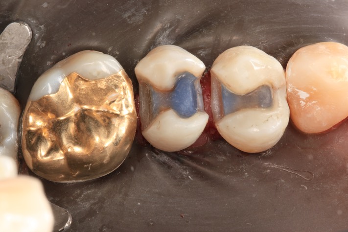 Kyle Chock #12-13 prep