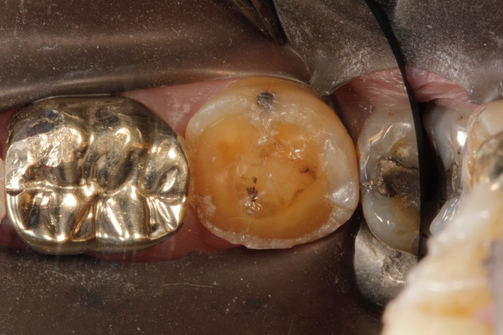 Larry Fujioka #18 pre-op