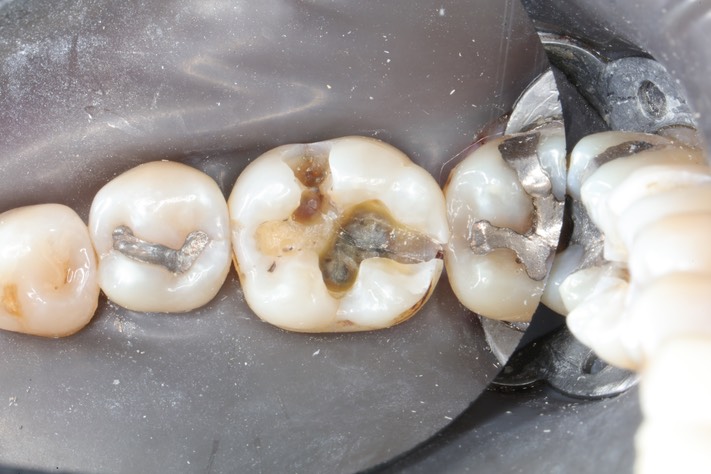 Larry Fujioka #19 amalgam removoal