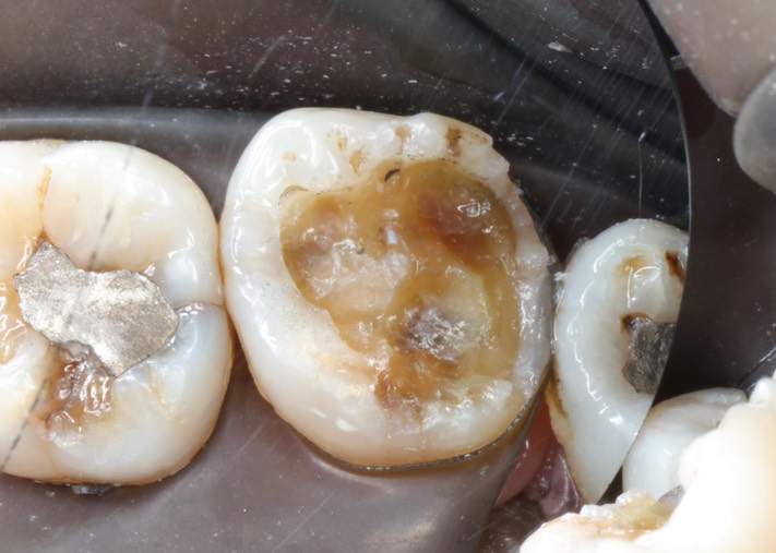 Larry Fujioka #2 caries removal