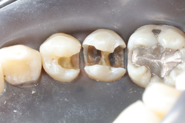 Larry Fujioka #20-21 caries removal