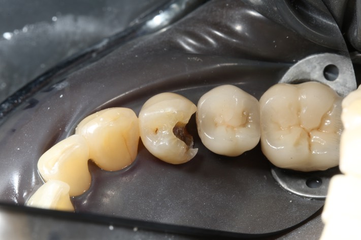 Larry Fujioka #21 amalgam removal